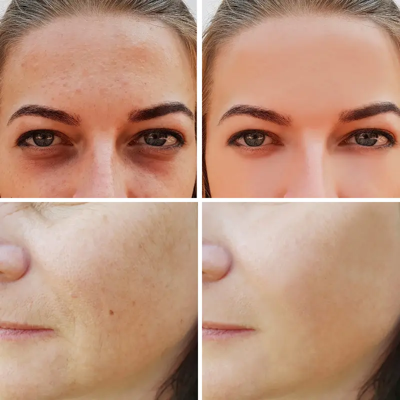 Before treatment result